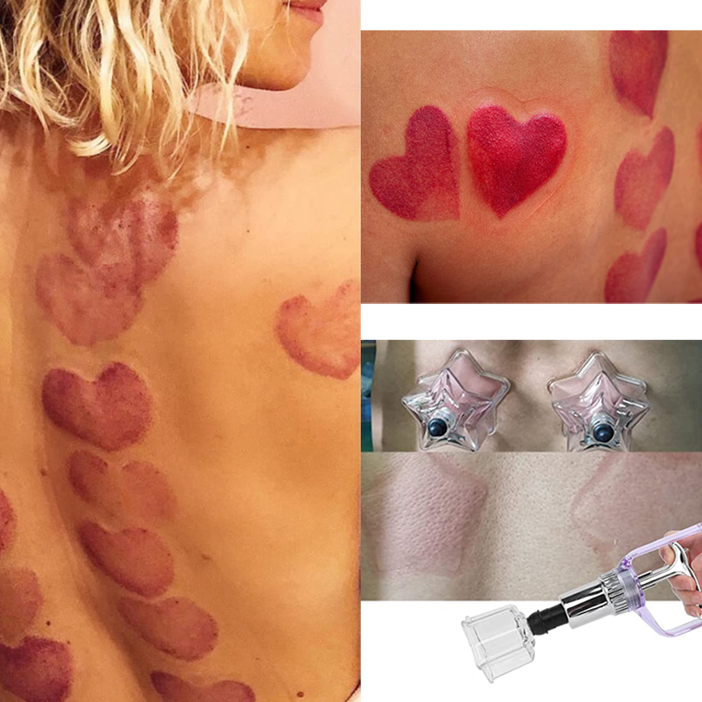 ชุดถ้วยดูดสูญญากาศบำบัดพลาสติก - Cupping Therapy Set บทวิจารณ์และราคา